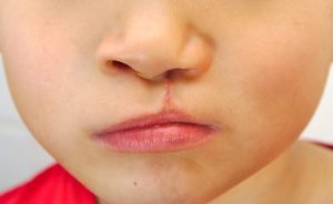 Boy showing unilateral cleft lip repaired.