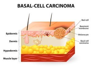 basal cell carcinoma