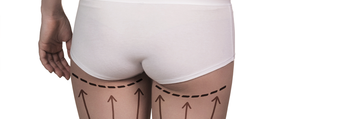 buttock lift auckland plastic surgical centre