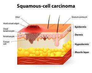 Squamous cell carcinoma