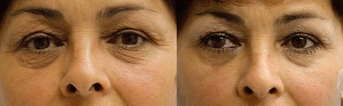 platelete Rich Plasma Treatment New Zealand