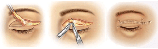 Eyelid surgery – Blepharoplasty