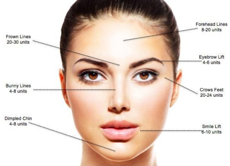 Anti-wrinkle injections