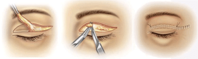 Brow Lift Procedure